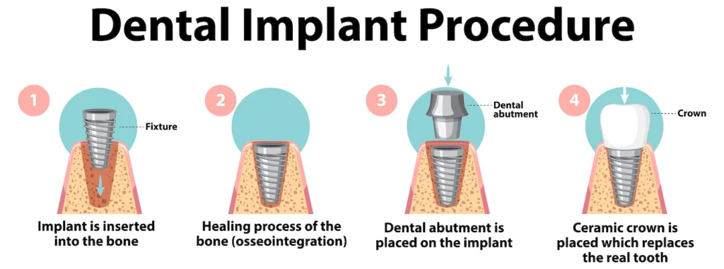 procedure implant dentaire