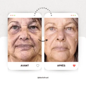 advatx Découvrez l'ADVATx : Le Traitement Laser Dermatologique de Pointe