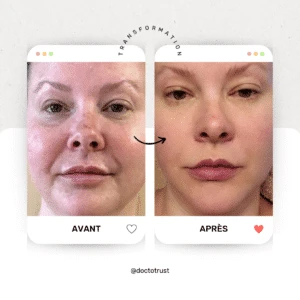 advatx avant apres Découvrez l'ADVATx : Le Traitement Laser Dermatologique de Pointe